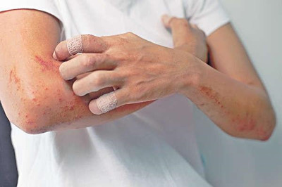长春肤康皮肤病专家浅谈中医如何治疗湿疹