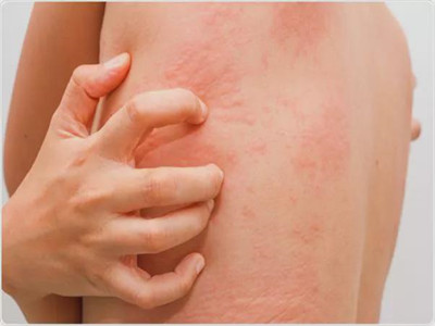 荨麻疹和过敏性皮炎的区别