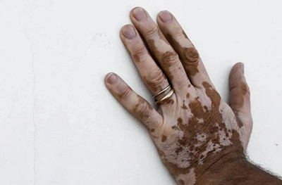 长春肤康皮肤病医院：白癜风的危害不只是白！